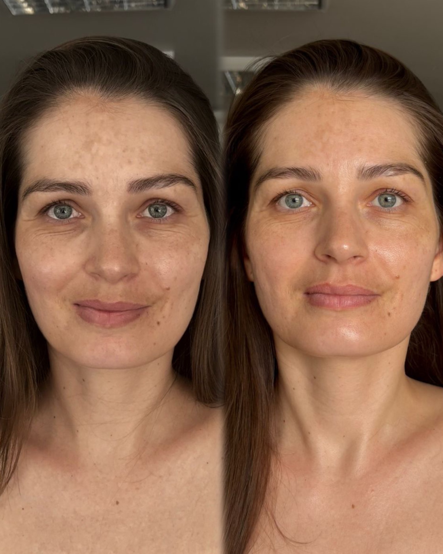 Výsledok po ošetrení - rozjasňujúca nanoterapia s Vitamínom C 